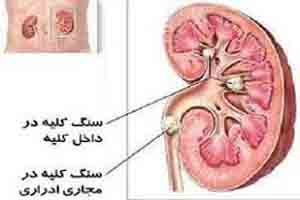 علائم وجود سنگ کلیه علائم وجود سنگ کلیه